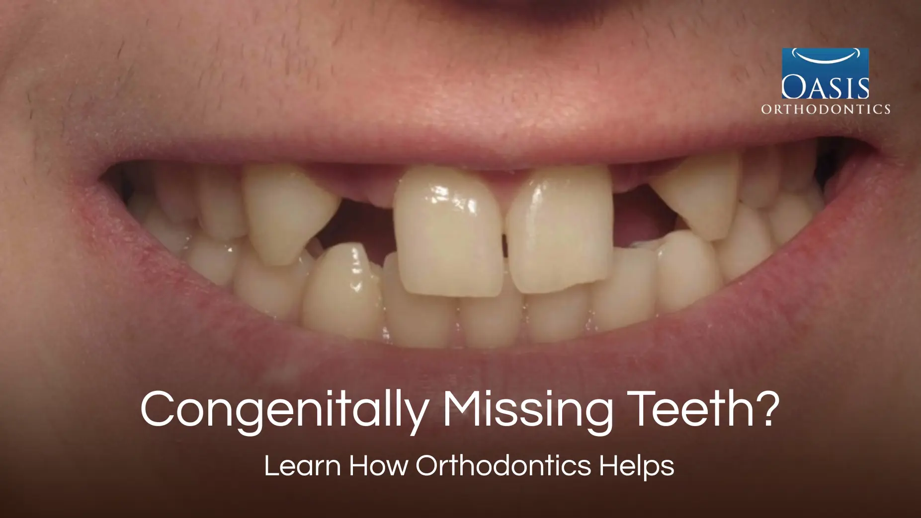 Congenitally missing teeth