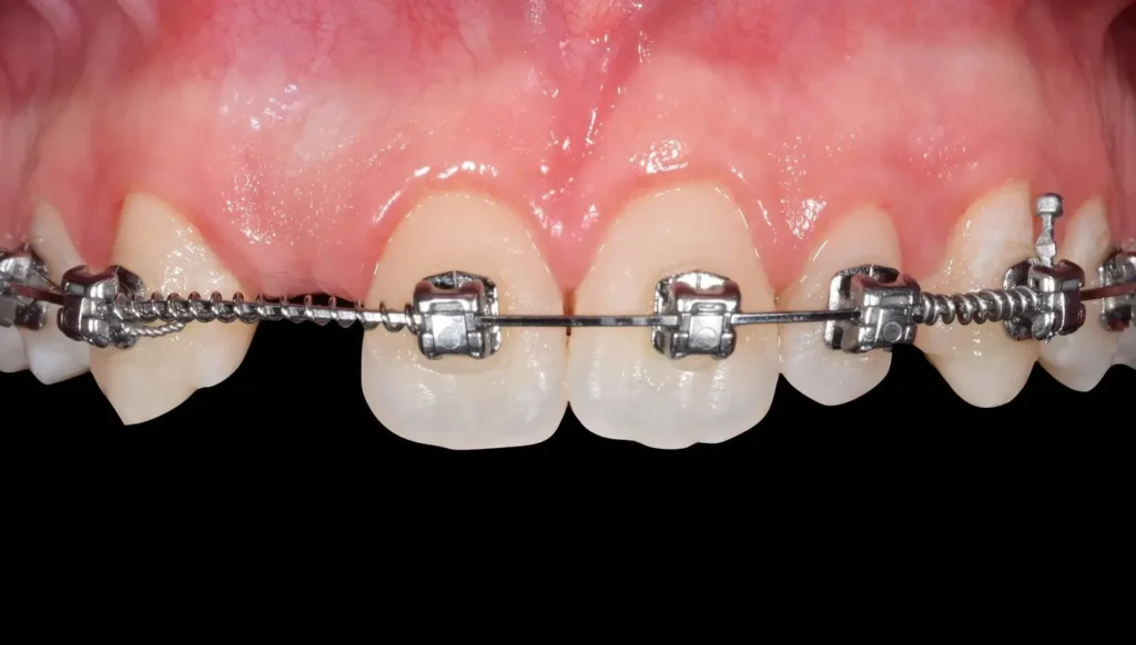 Space Closure congenitally missing teeth treatment