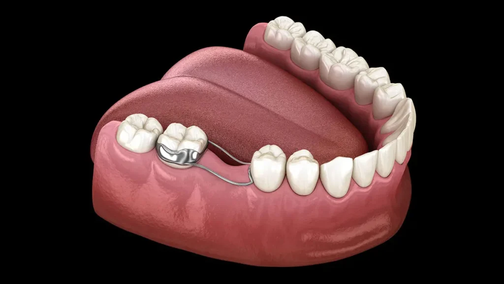 Space Maintenance congenitally missing teeth treatment