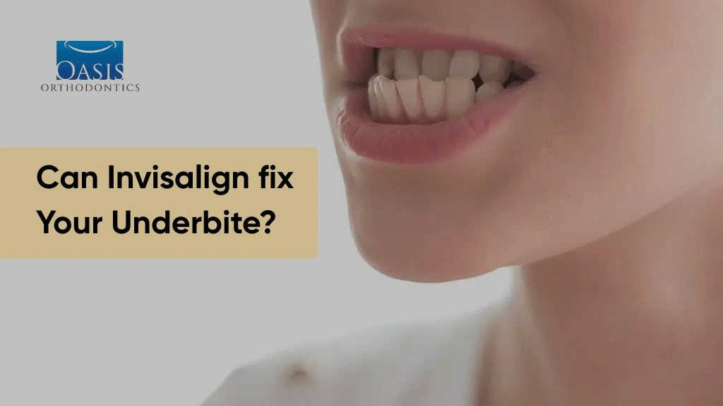 Can-Invisalign-Fix-Your-Underbite